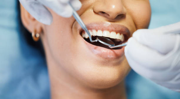Best Knocked-Out Tooth (Avulsed Tooth) Treatment in Childress, TX